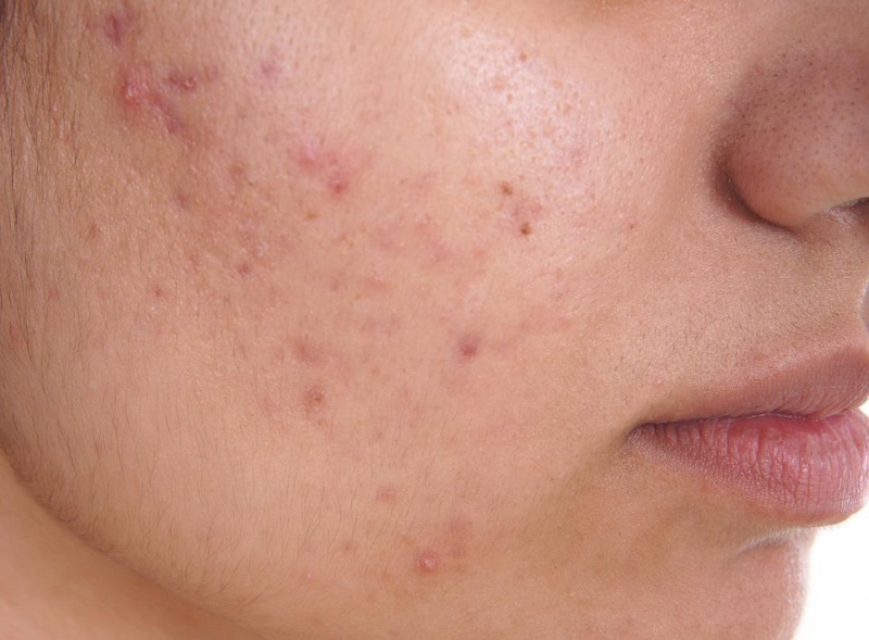 common skin diseases