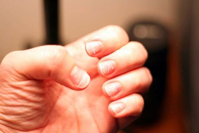 How to repair damaged nails after acrylics