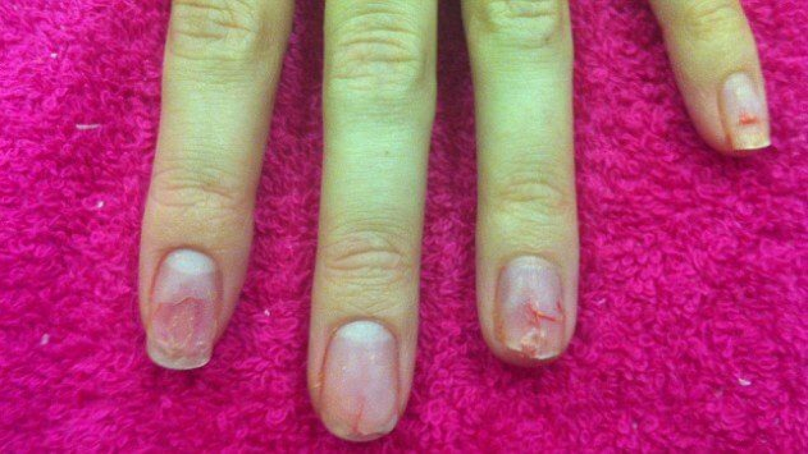how to repair damaged nails after acrylics